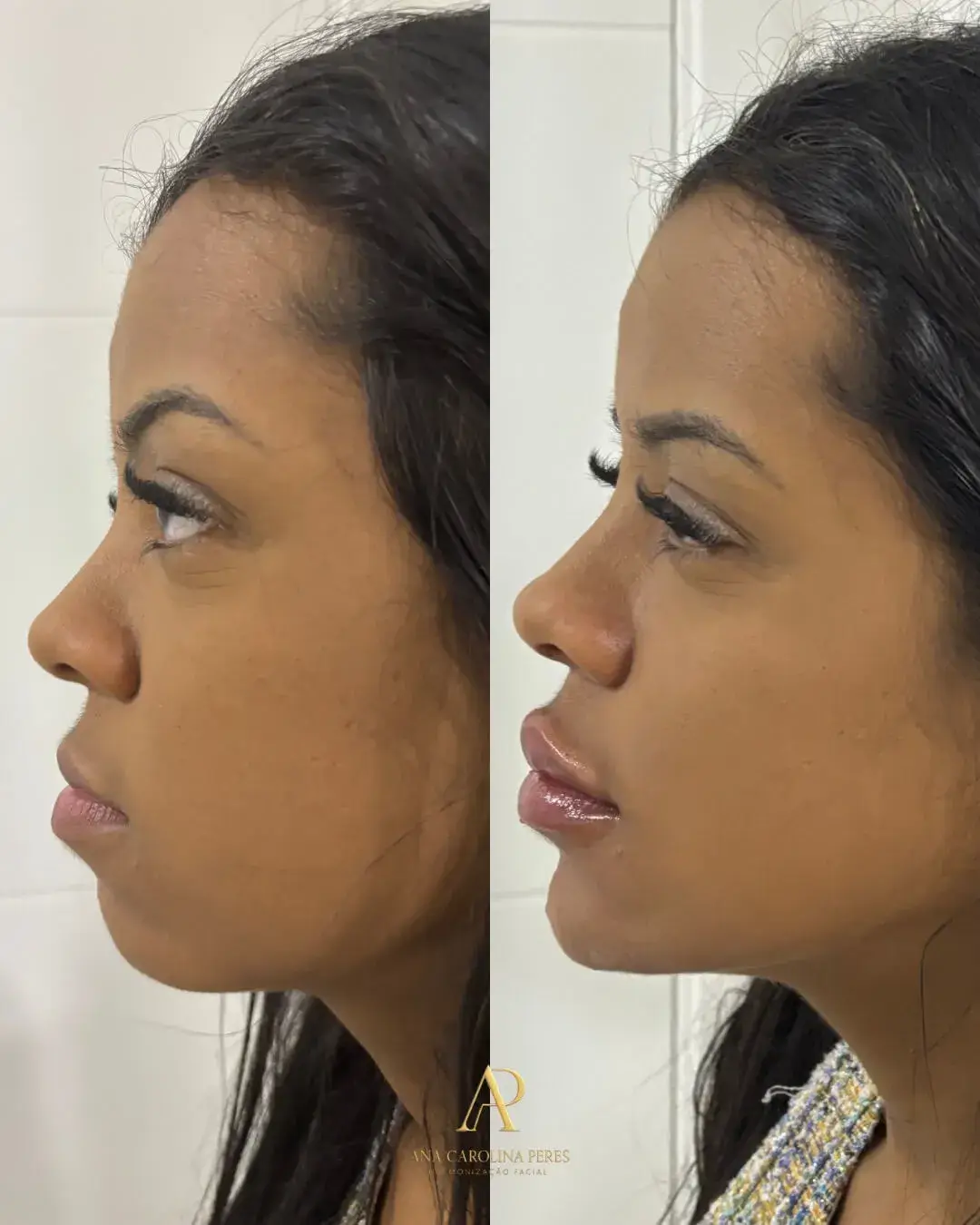 Resultado de harmonização facial — antes e depois 1