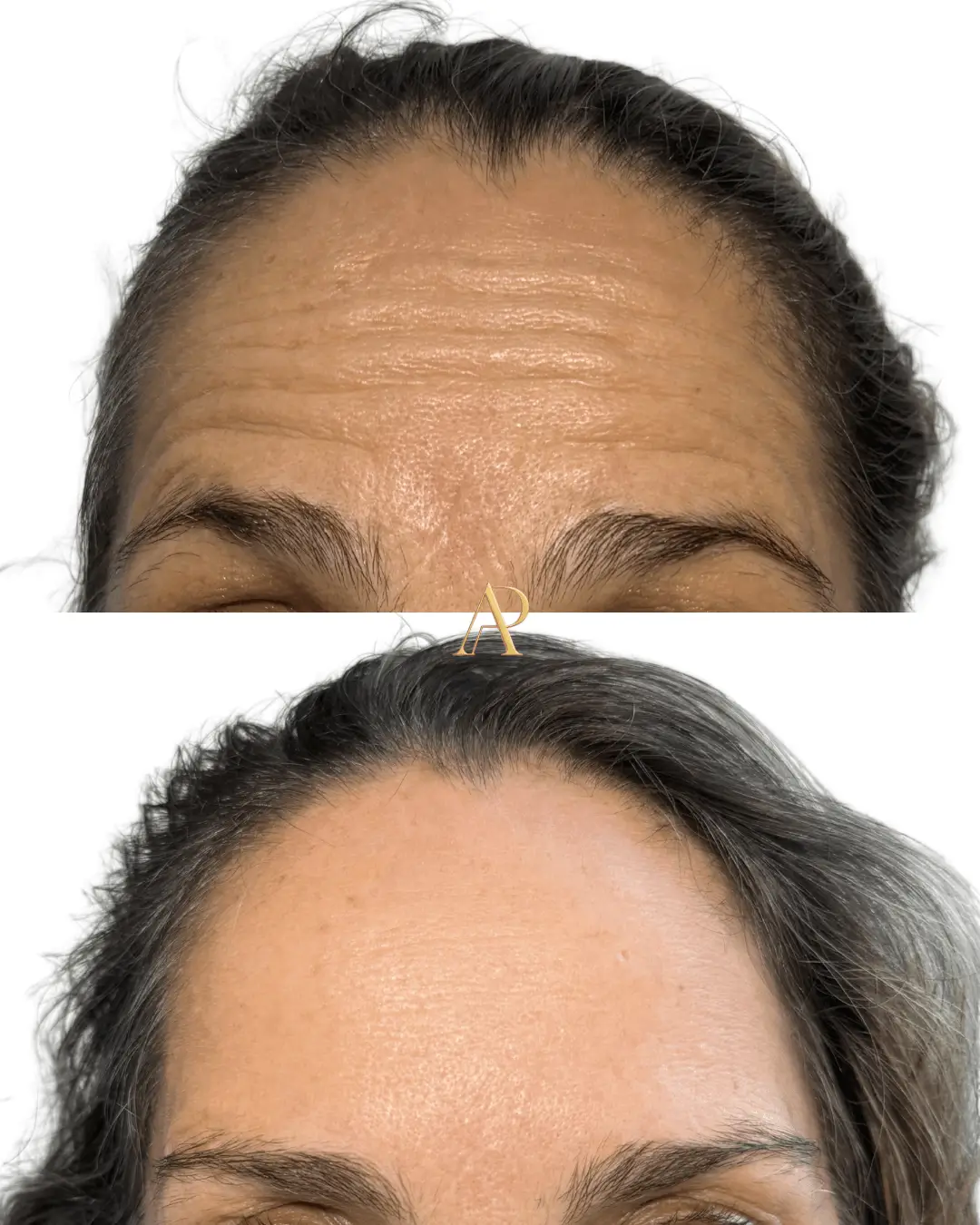 Resultado de harmonização facial — antes e depois 3