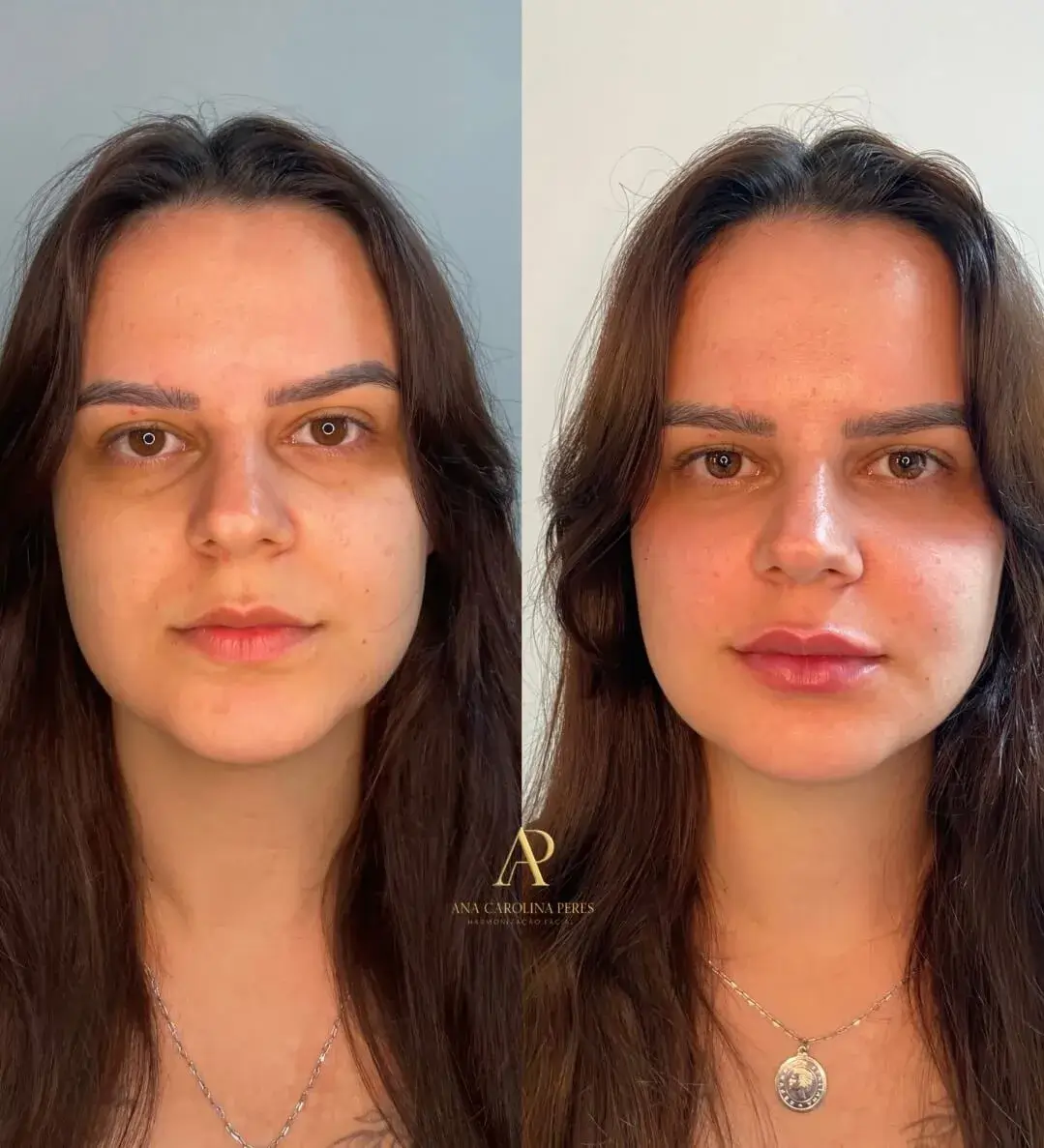 Resultado de harmonização facial — antes e depois 4