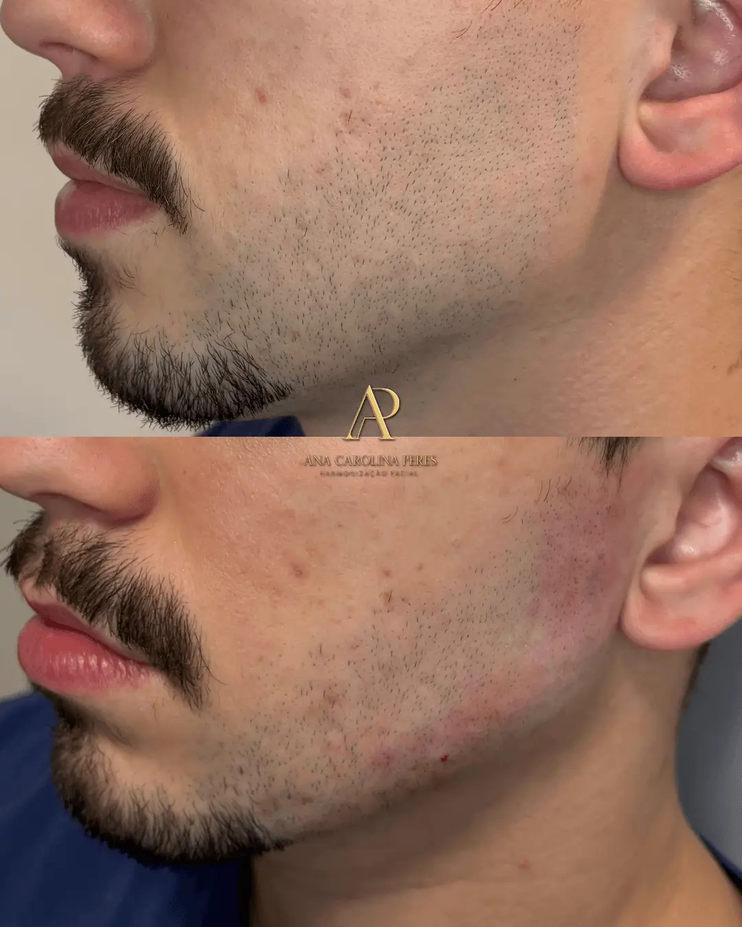 Resultado de harmonização facial — antes e depois 5