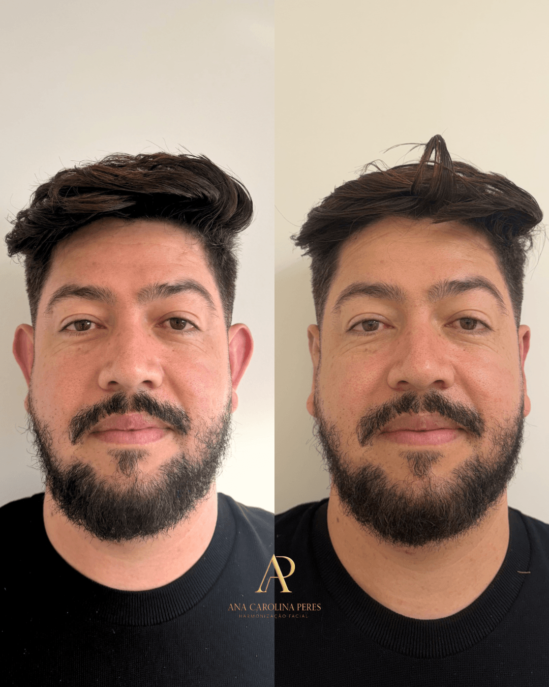 Antes e depois de otomodelação Método CDT — resultado 2