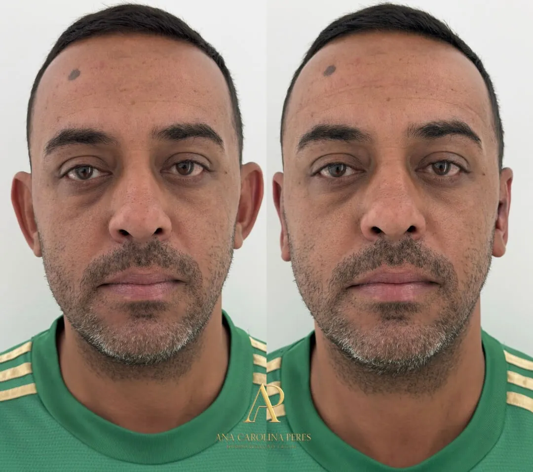 Antes e depois de otomodelação Método CDT — resultado 1